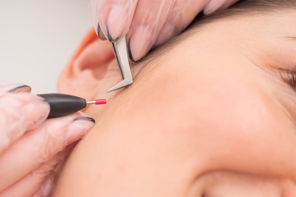 Electrolysis - Soma Laser Skincare Clinic