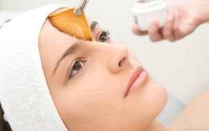 Lamelle skin peels at Soma Laser Pretoria