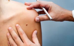 Electrolysis at Soma Laser Pretoria