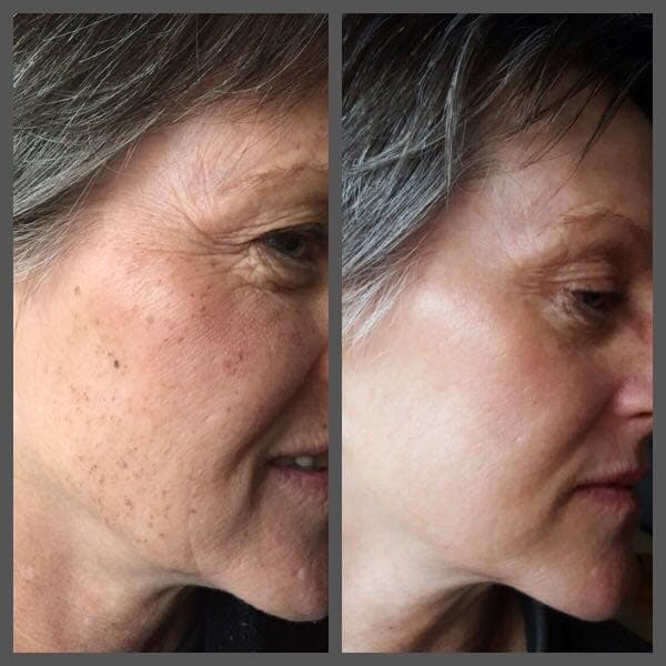 IPL before and after - Soma Laser - Skincare clinic - Pretoria - Customised skin and hair treatments. Stockists of Dermalogica, Lamelle, MD Lash Factor and Heliocare