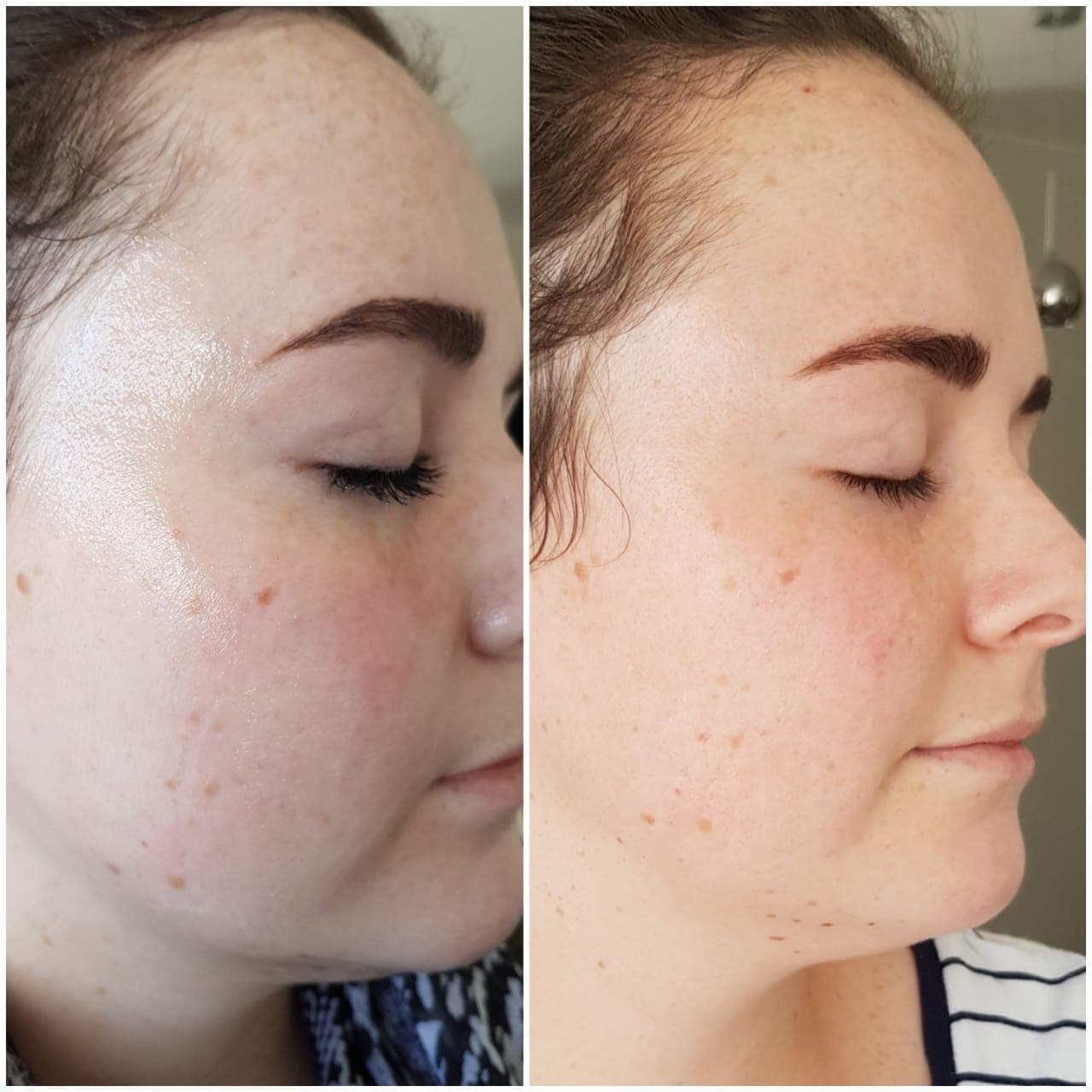 IPL before and after - Soma Laser - Skincare clinic - Pretoria - Customised skin and hair treatments. Stockists of Dermalogica, Lamelle, MD Lash Factor and Heliocare
