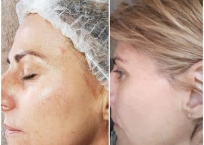 IPL before and after - Soma Laser - Skincare clinic - Pretoria - Customised skin and hair treatments. Stockists of Dermalogica, Lamelle, MD Lash Factor and Heliocare