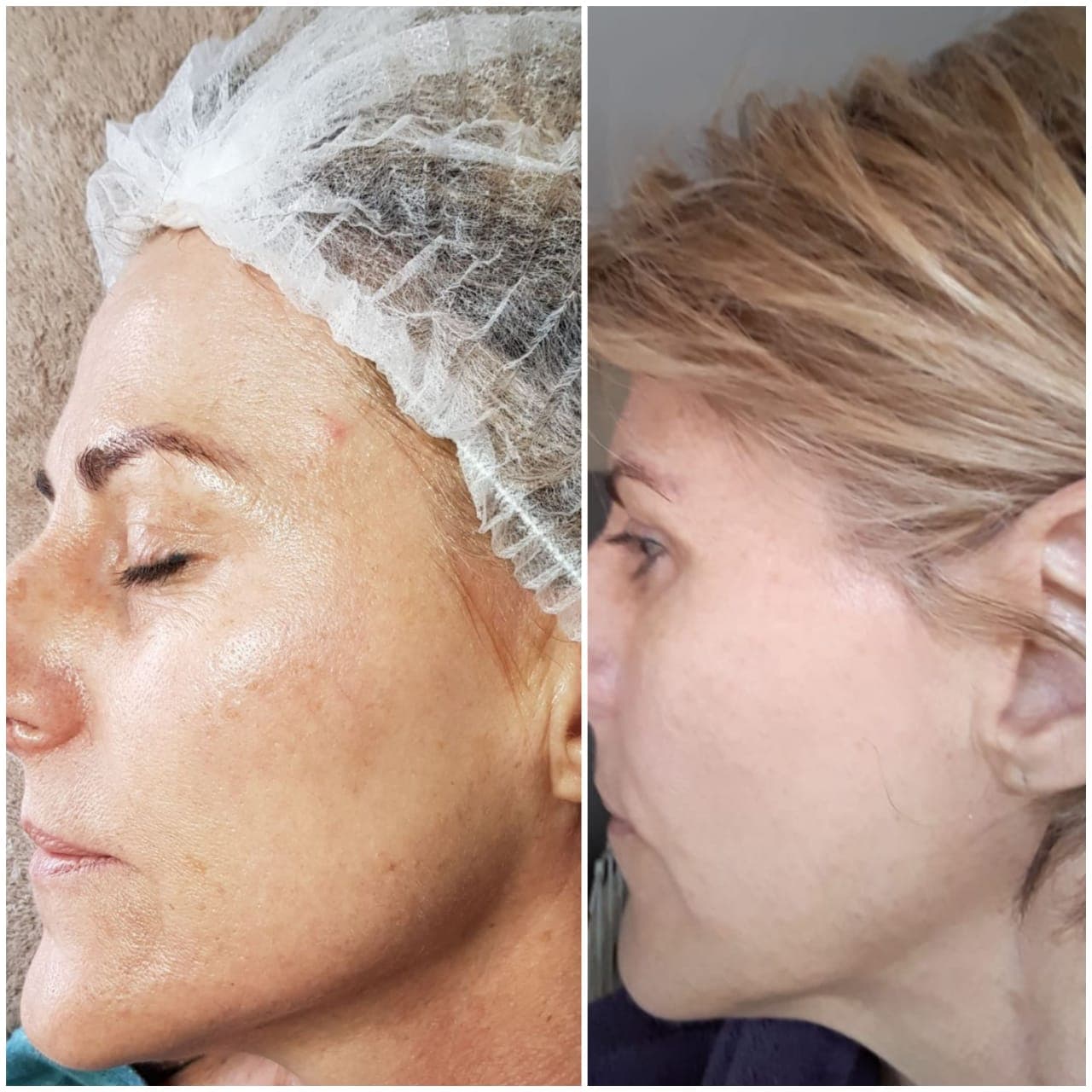 IPL before and after - Soma Laser - Skincare clinic - Pretoria - Customised skin and hair treatments. Stockists of Dermalogica, Lamelle, MD Lash Factor and Heliocare