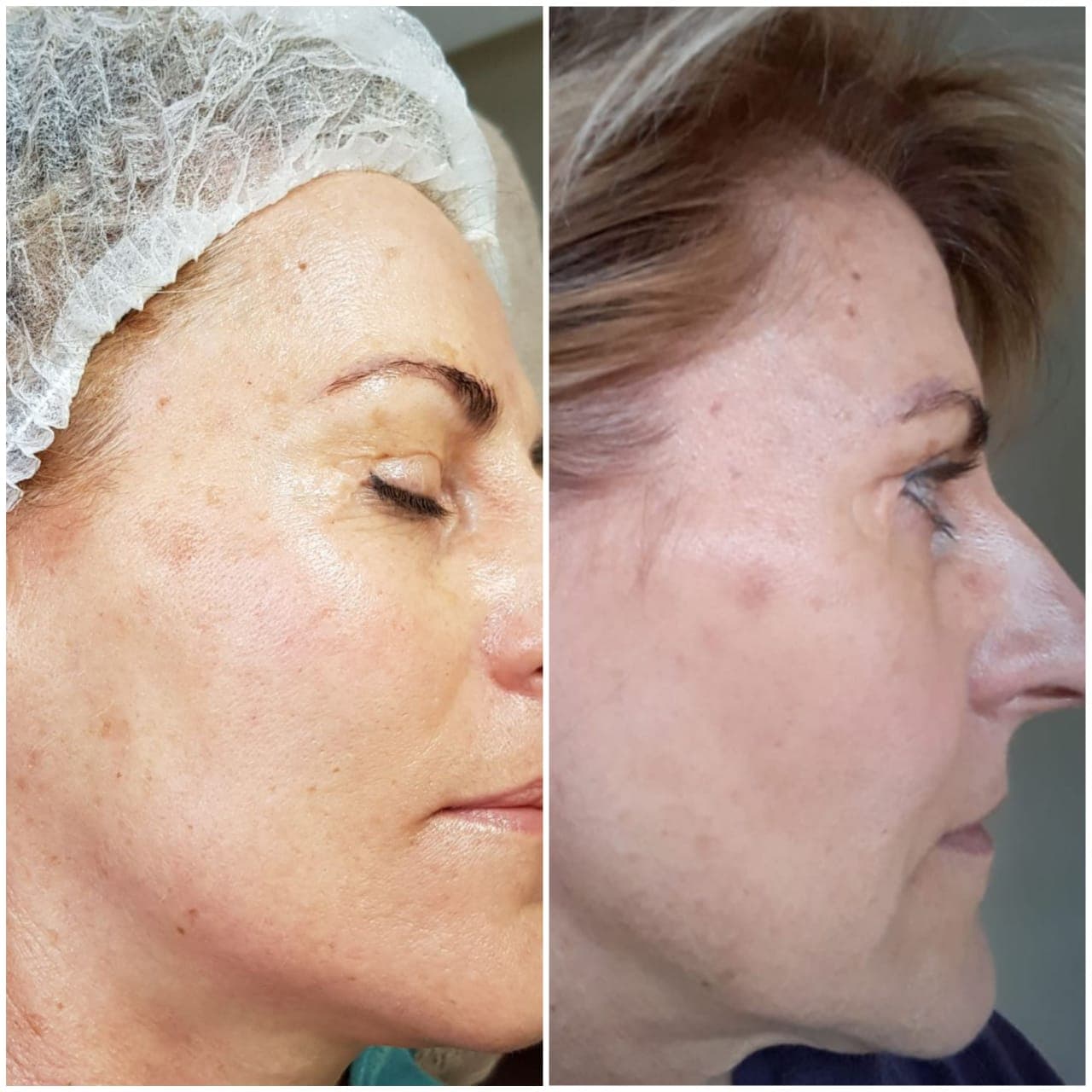 IPL before and after - Soma Laser - Skincare clinic - Pretoria - Customised skin and hair treatments. Stockists of Dermalogica, Lamelle, MD Lash Factor and Heliocare