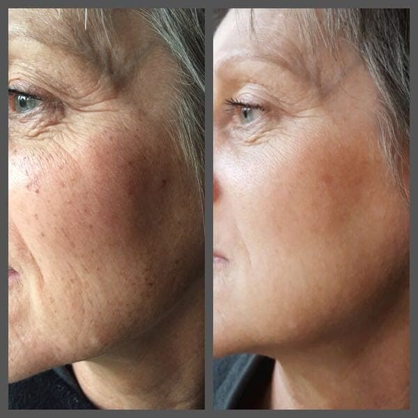 IPL before and after - Soma Laser - Skincare clinic - Pretoria - Customised skin and hair treatments. Stockists of Dermalogica, Lamelle, MD Lash Factor and Heliocare