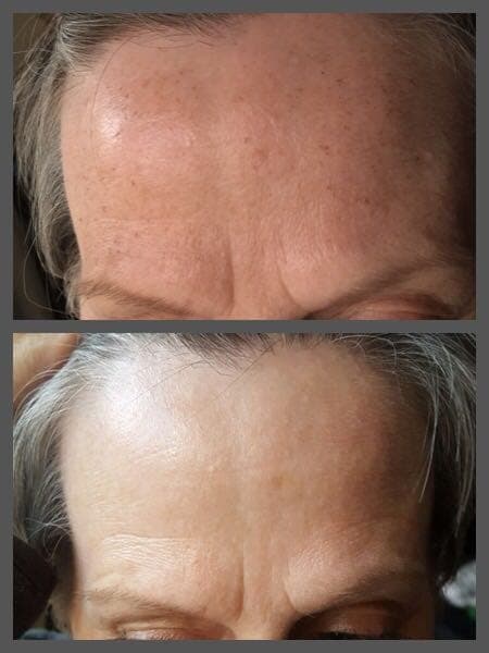 IPL before and after - Soma Laser - Skincare clinic - Pretoria - Customised skin and hair treatments. Stockists of Dermalogica, Lamelle, MD Lash Factor and Heliocare