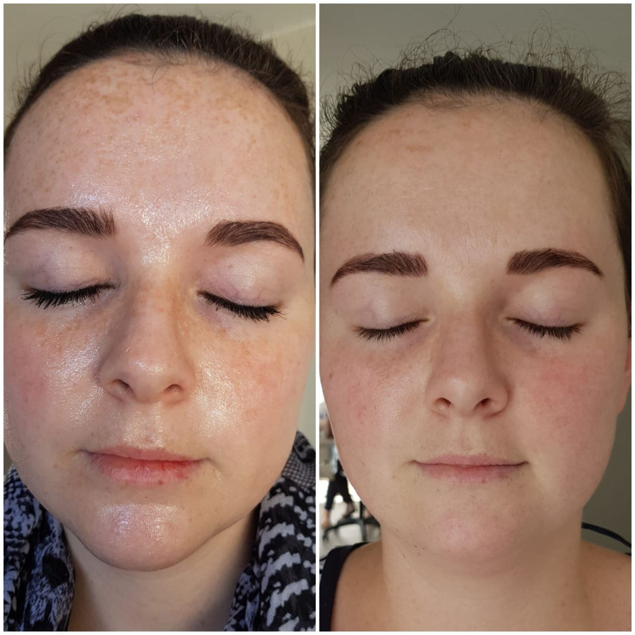 IPL before and after - Soma Laser - Skincare clinic - Pretoria - Customised skin and hair treatments. Stockists of Dermalogica, Lamelle, MD Lash Factor and Heliocare