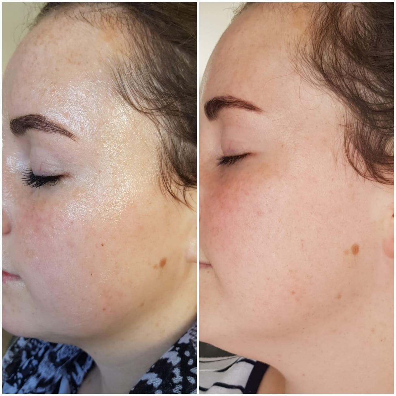IPL before and after - Soma Laser - Skincare clinic - Pretoria - Customised skin and hair treatments. Stockists of Dermalogica, Lamelle, MD Lash Factor and Heliocare