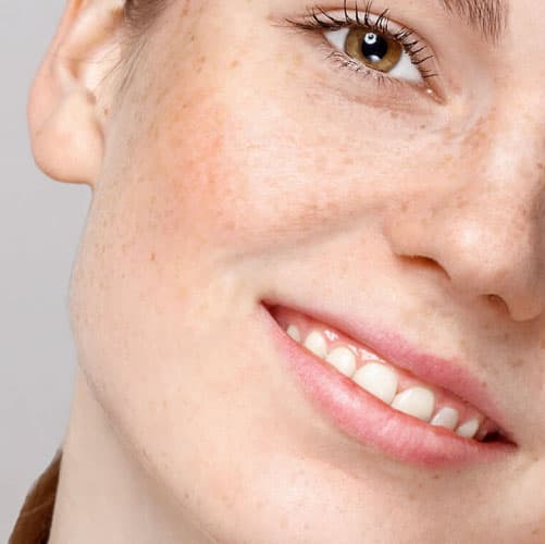 Pigmentation: Sun