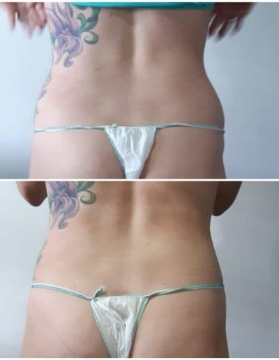 4 Fat Freeze - Soma Laser - Skincare clinic - Pretoria - Customised skin and hair treatments. Stockists of Dermalogica, Lamelle, MD Lash Factor and Heliocare