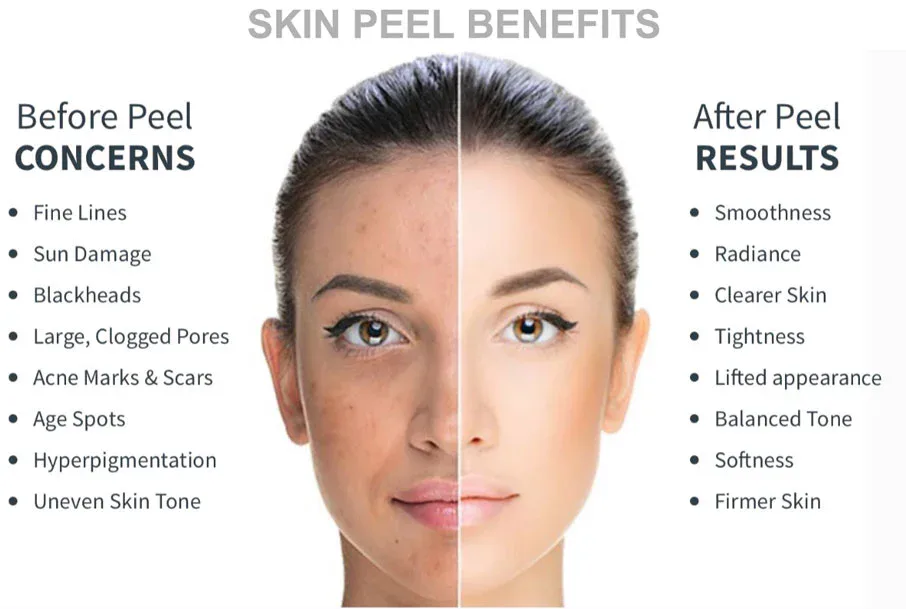 Peel-Results Skin Peeling