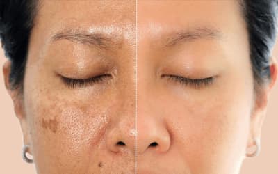 Understanding Melasma and How Soma Laser & Skincare Clinic Can Help
