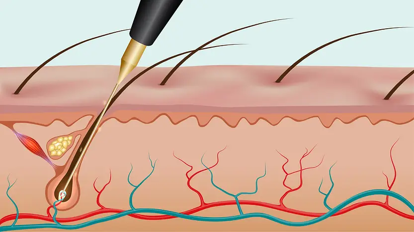 Electrolysis offered by Soma Laser and Skincare Clinic Electrolysis offered by Soma Laser and Skincare Clinic