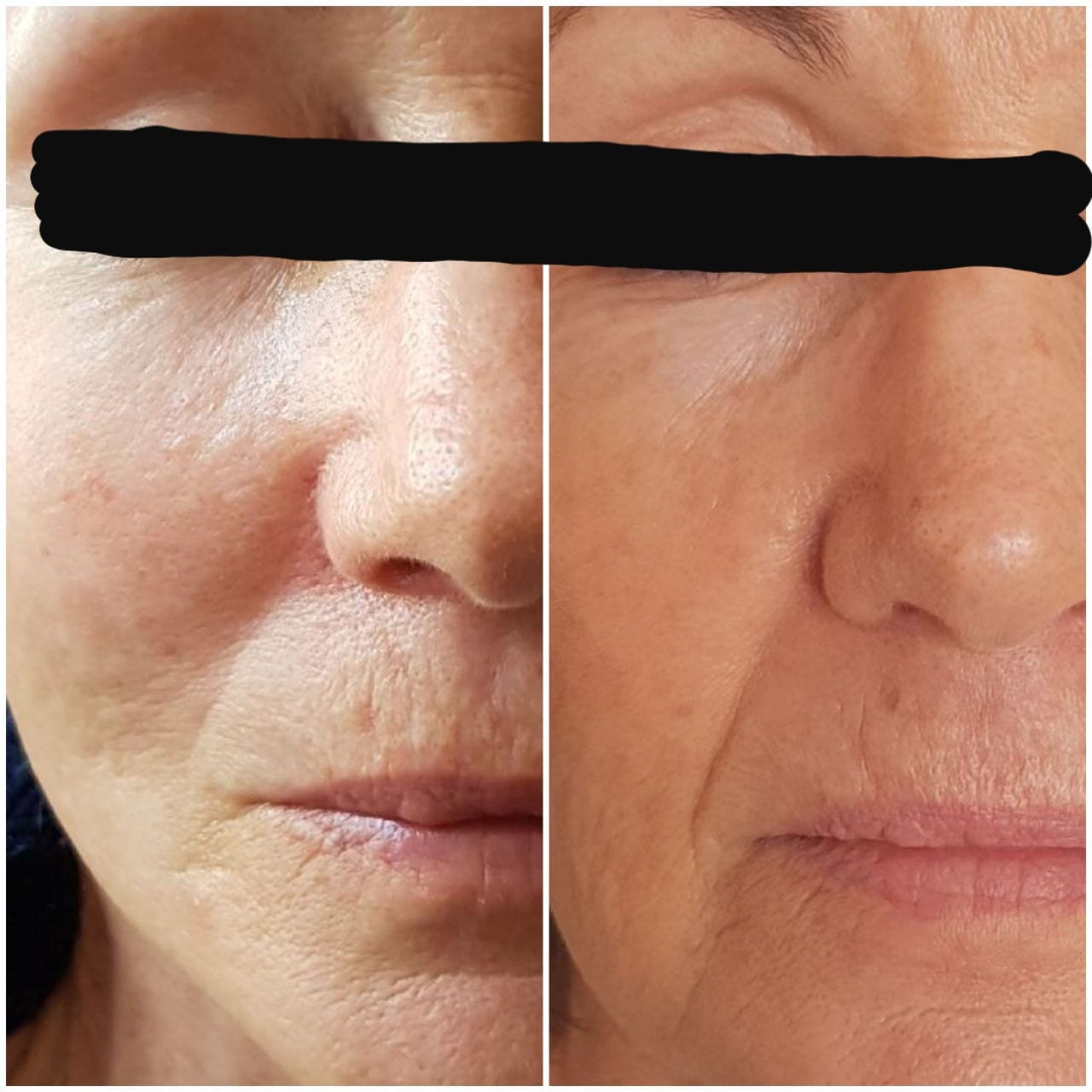 IPL before and after - Soma Laser - Skincare clinic - Pretoria - Customised skin and hair treatments. Stockists of Dermalogica, Lamelle, MD Lash Factor and Heliocare