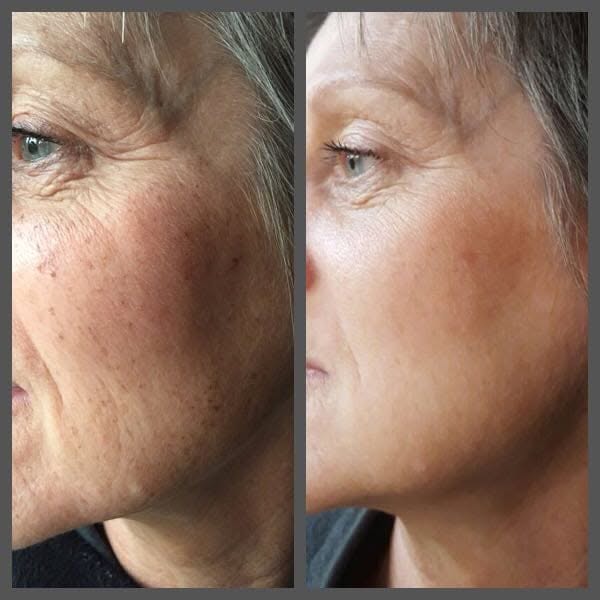 IPL before and after - Soma Laser - Skincare clinic - Pretoria - Customised skin and hair treatments. Stockists of Dermalogica, Lamelle, MD Lash Factor and Heliocare