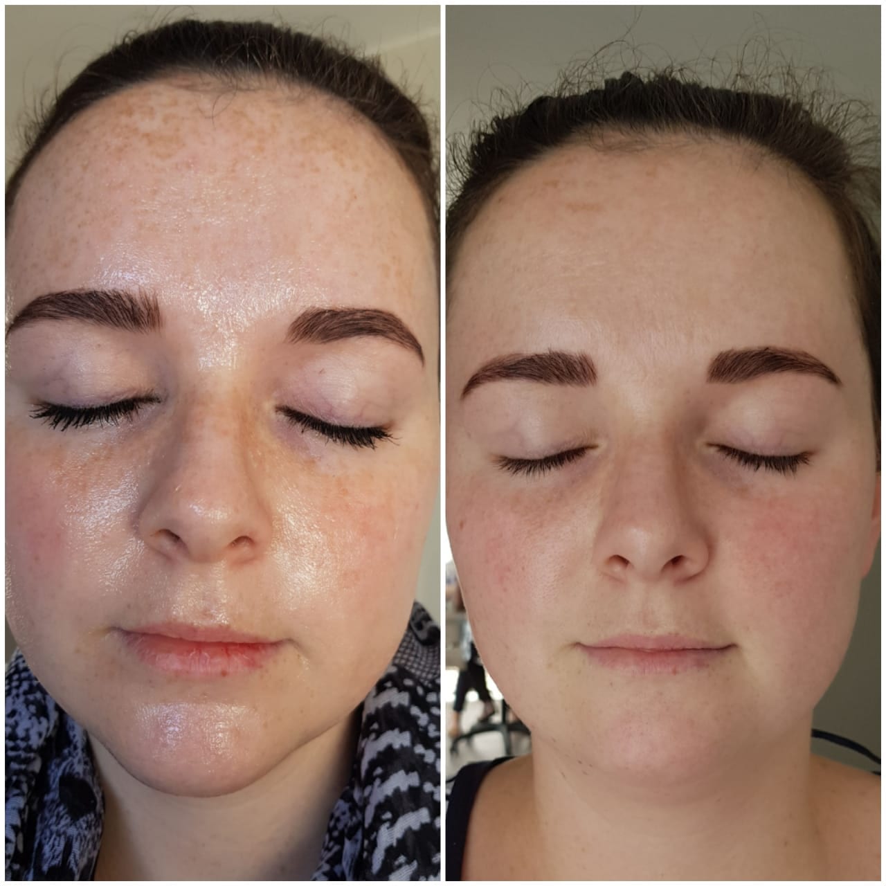 IPL before and after - Soma Laser - Skincare clinic - Pretoria - Customised skin and hair treatments. Stockists of Dermalogica, Lamelle, MD Lash Factor and Heliocare