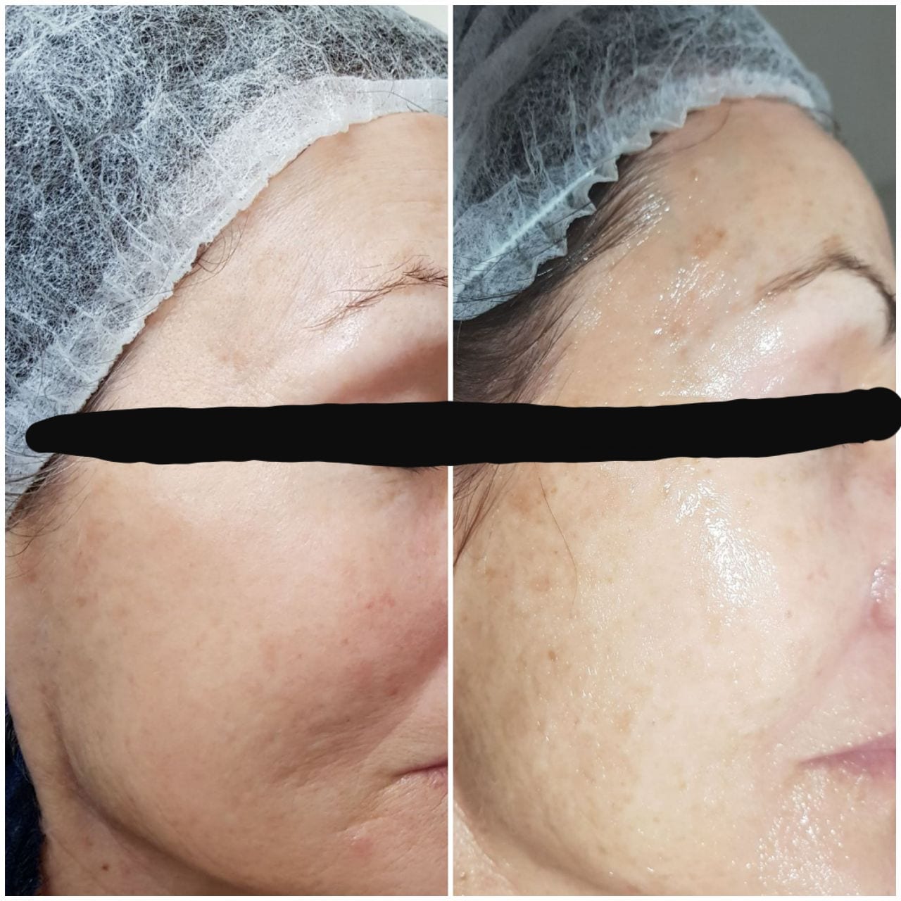 IPL before and after - Soma Laser - Skincare clinic - Pretoria - Customised skin and hair treatments. Stockists of Dermalogica, Lamelle, MD Lash Factor and Heliocare