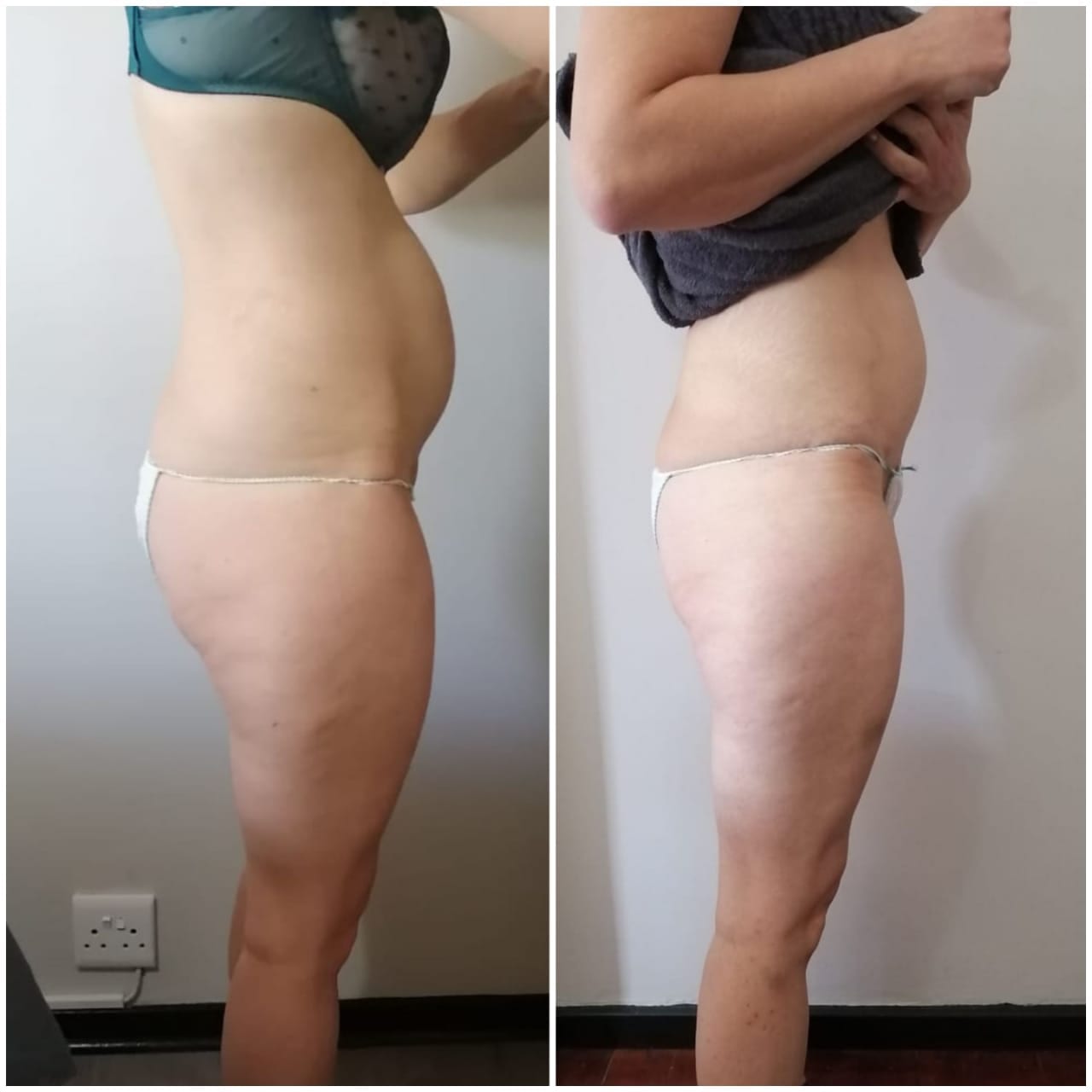1 Fat Freeze - Soma Laser - Skincare clinic - Pretoria - Customised skin and hair treatments. Stockists of Dermalogica, Lamelle, MD Lash Factor and Heliocare