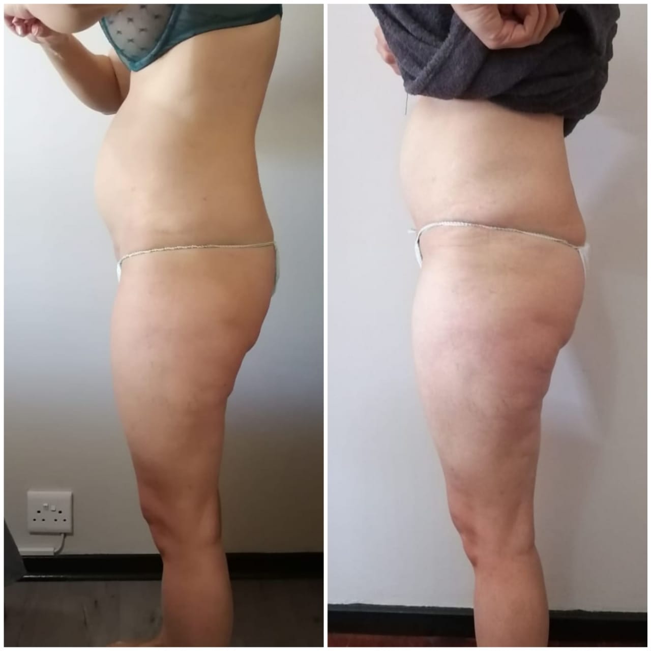 2 Fat Freeze - Soma Laser - Skincare clinic - Pretoria - Customised skin and hair treatments. Stockists of Dermalogica, Lamelle, MD Lash Factor and Heliocare