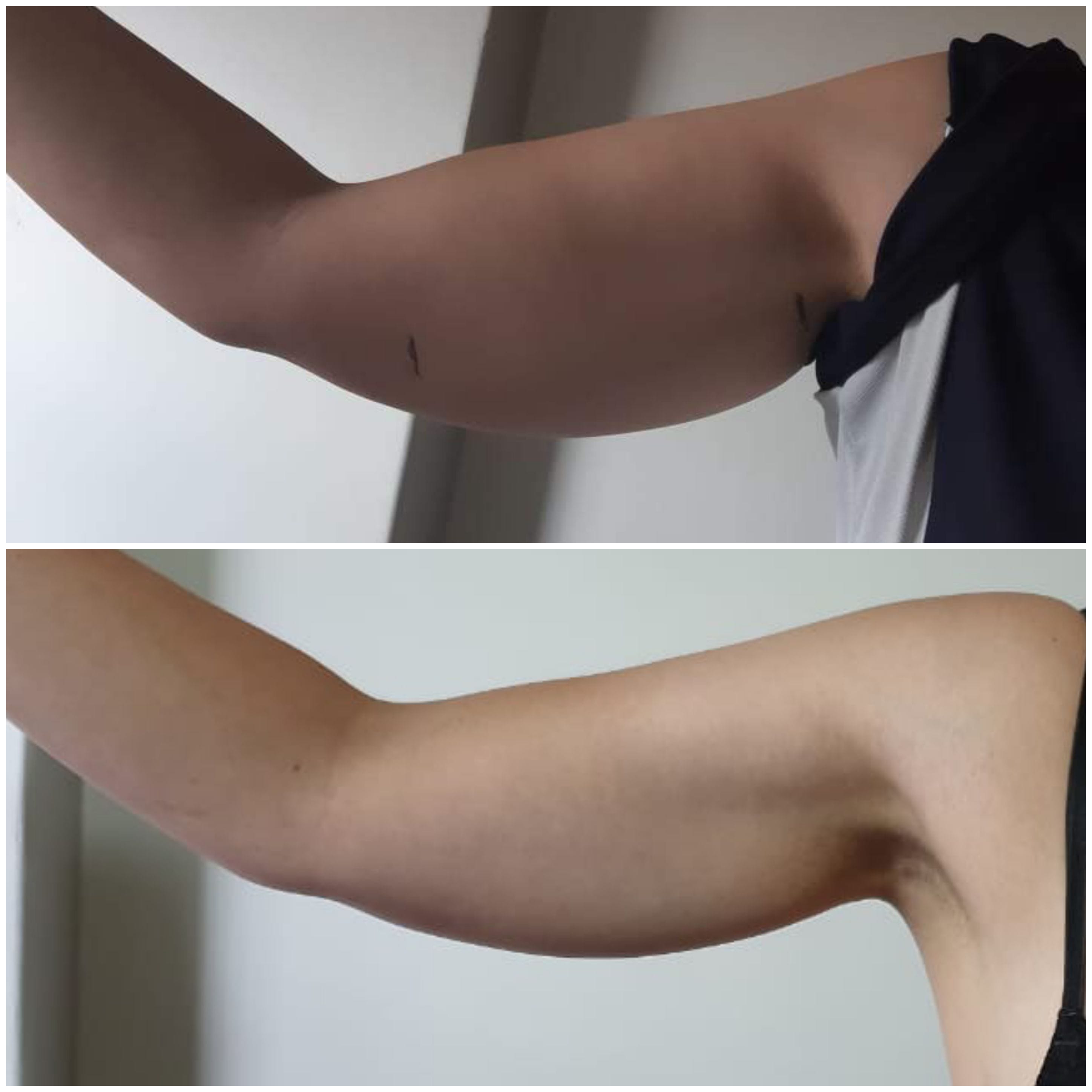 3 Fat Freeze - Soma Laser - Skincare clinic - Pretoria - Customised skin and hair treatments. Stockists of Dermalogica, Lamelle, MD Lash Factor and Heliocare