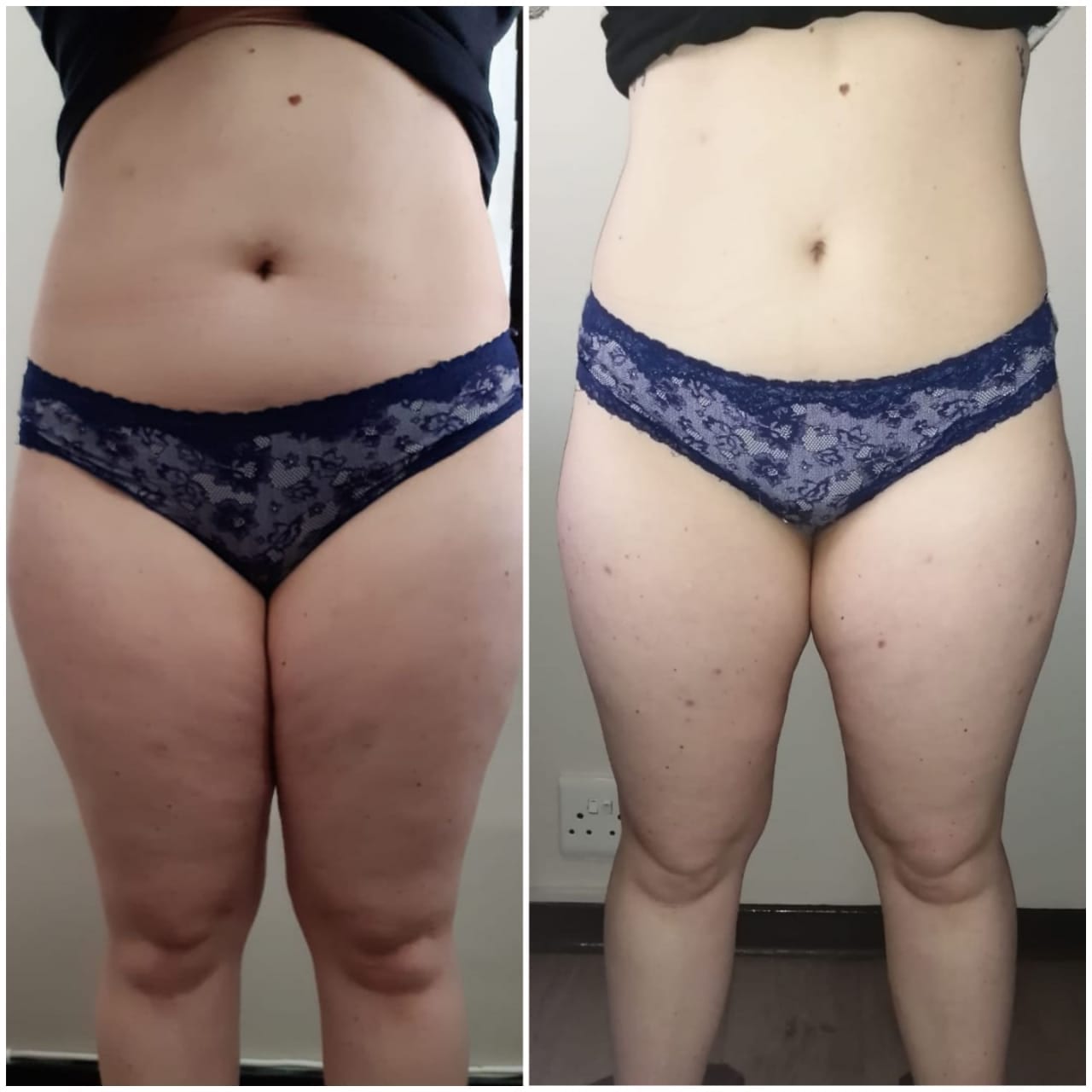 5 Fat Freeze - Soma Laser - Skincare clinic - Pretoria - Customised skin and hair treatments. Stockists of Dermalogica, Lamelle, MD Lash Factor and Heliocare