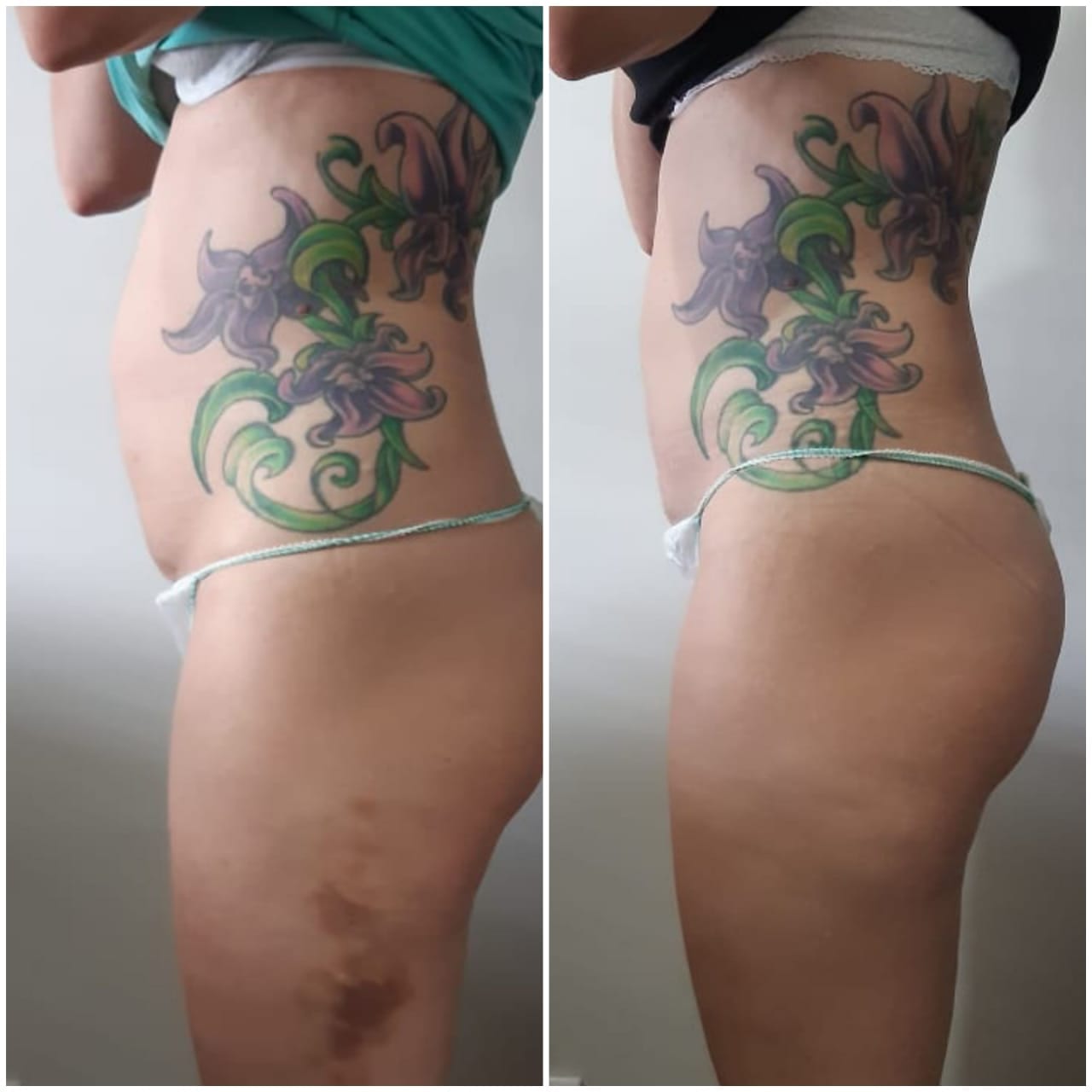 6 Fat Freeze - Soma Laser - Skincare clinic - Pretoria - Customised skin and hair treatments. Stockists of Dermalogica, Lamelle, MD Lash Factor and Heliocare