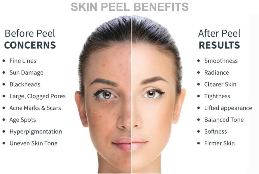 Peel-Results Skin Peeling