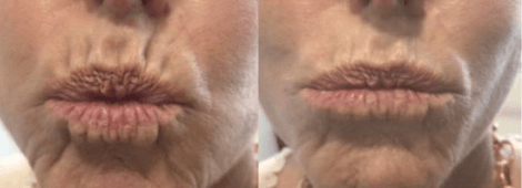 BionutriLIPS-1 anti-wrinkle - SomaLaser - Dr. Zandia Bronkhorst - Aesthetic Doctor - pretoria east