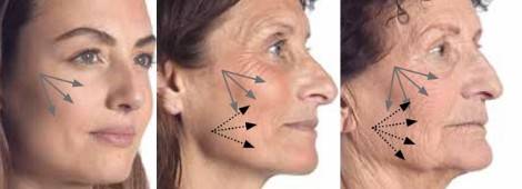 Bionutrilift-NEW2 anti-wrinkle - SomaLaser - Dr. Zandia Bronkhorst - Aesthetic Doctor - pretoria east