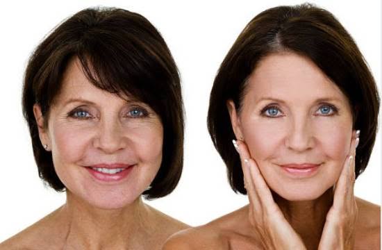 skin boosters anti-wrinkle - SomaLaser - Dr. Zandia Bronkhorst - Aesthetic Doctor - pretoria east